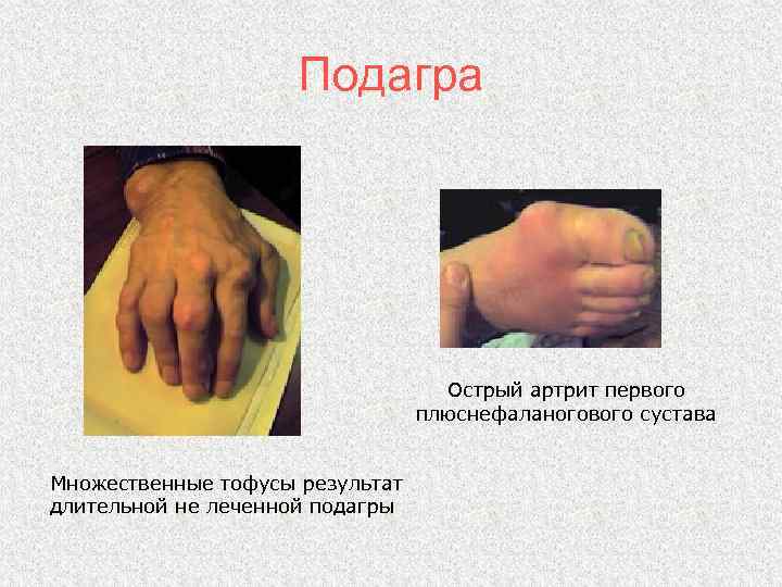 Подагра Острый артрит первого плюснефаланогового сустава Множественные тофусы результат длительной не леченной подагры 