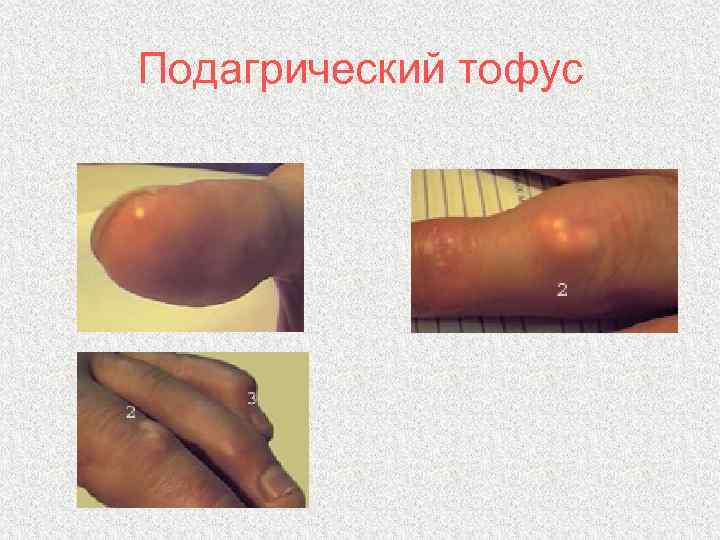 Подагрический тофус 