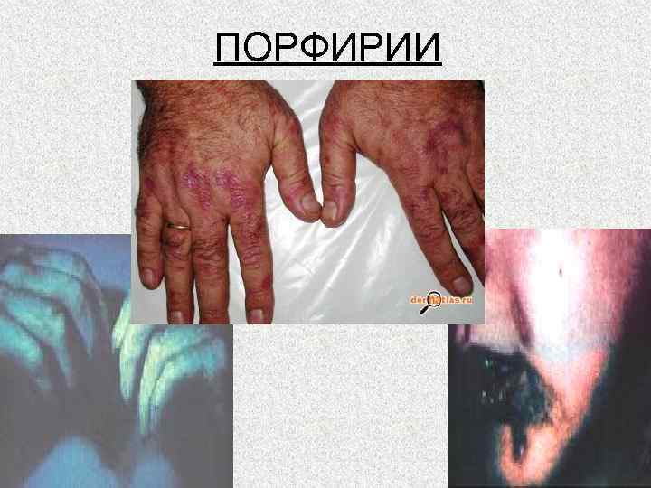 ПОРФИРИИ 