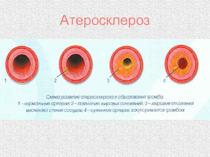 Атеросклероз 