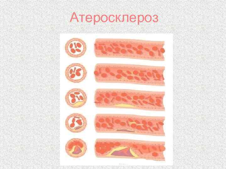 Атеросклероз 