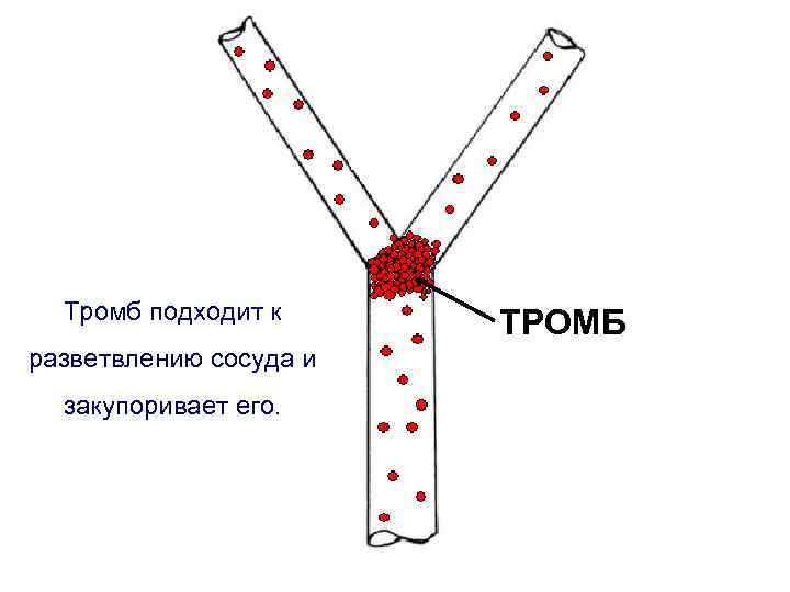Тромб подходит к разветвлению сосуда и закупоривает его. ТРОМБ 