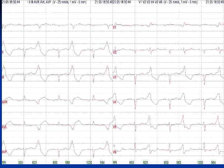 Запись ЭКГ в 12 -ти отведениях при ХМ 
