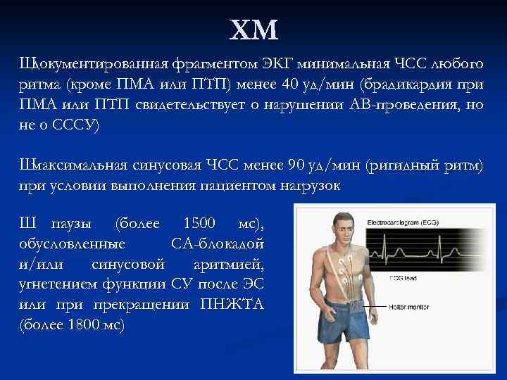 XM Ш документированная фрагментом ЭКГ минимальная ЧСС любого ритма (кроме ПМА или ПТП) менее