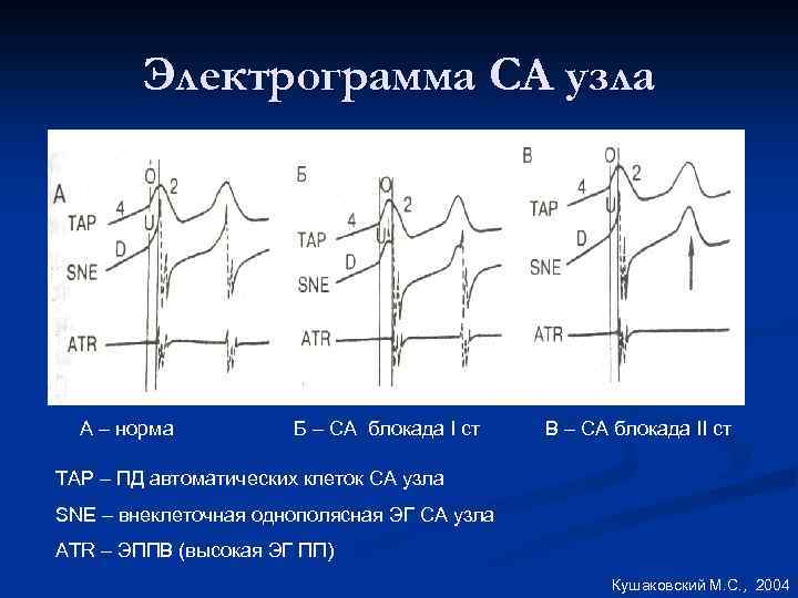 Электрограмма СА узла A – норма Б – СА блокада I ст В –