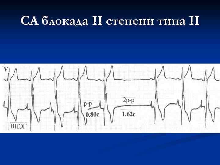 СА блокада II степени типа II 