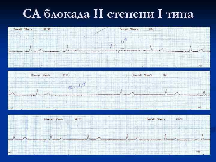 СА блокада II степени I типа 