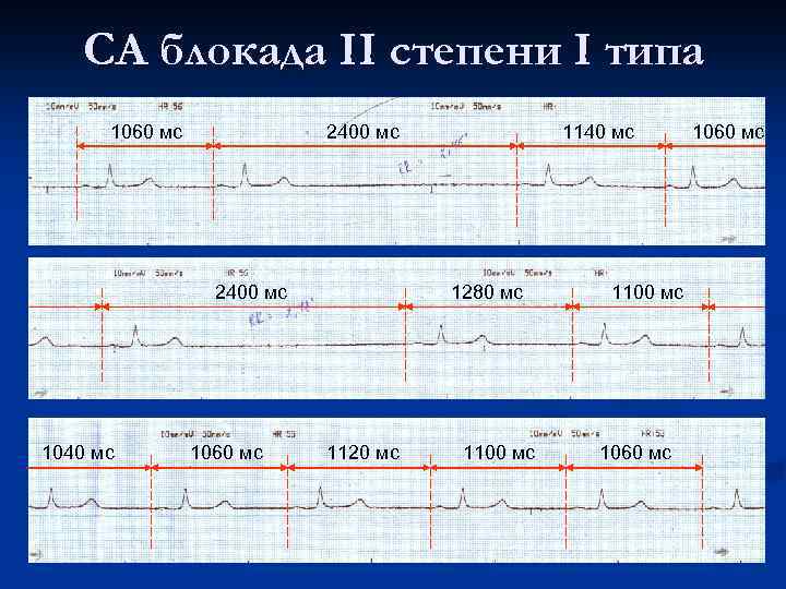 СА блокада II степени I типа 1060 мс 2400 мс 1040 мс 1060 мс