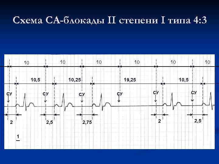 Схема СА-блокады II степени I типа 4: 3 10 10 10, 5 СУ 2,