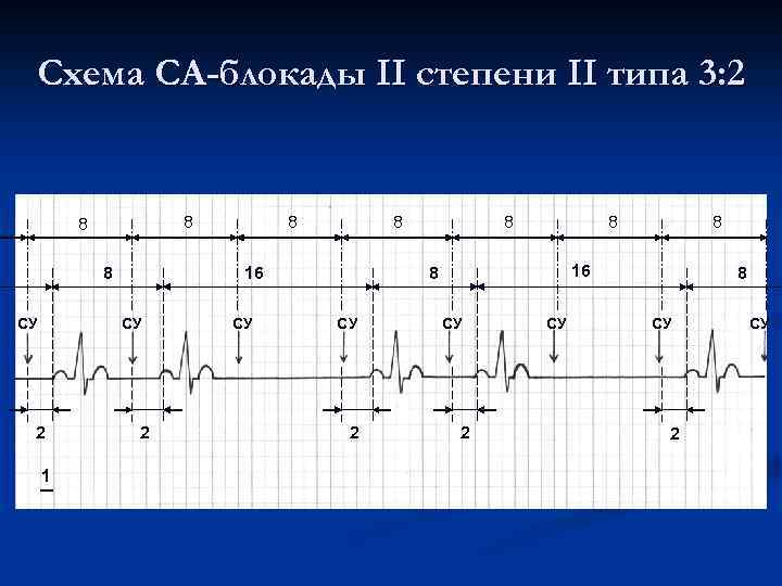 Схема СА-блокады II степени II типа 3: 2 8 8 8 СУ 1 8