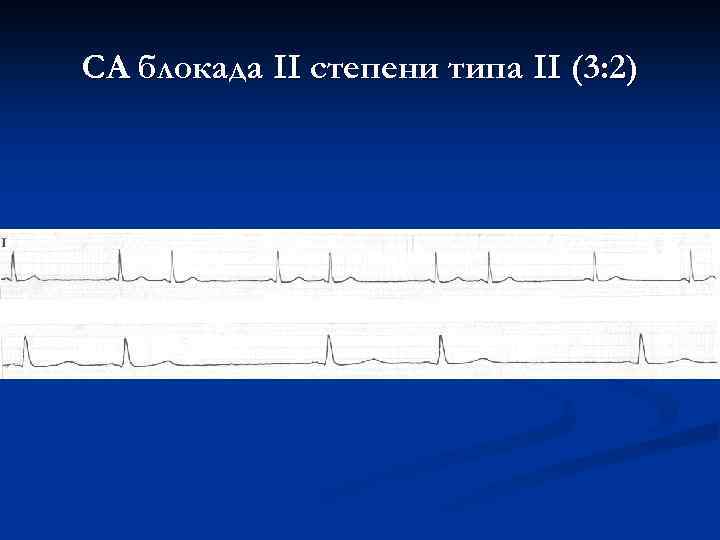 СА блокада II степени типа II (3: 2) 