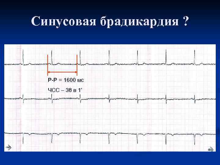Синусовая брадикардия ? P-P = 1600 мс ЧСС – 38 в 1’ 