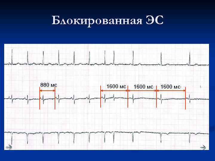 Блокированная ЭС 880 мс 1600 мс 