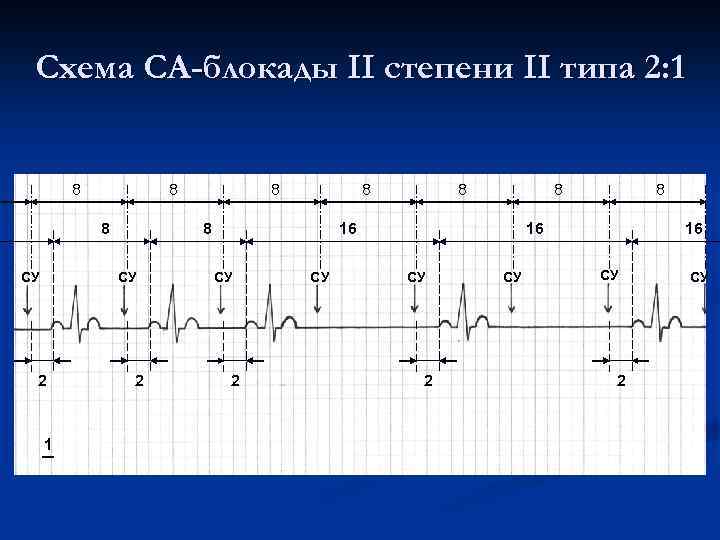 Схема СА-блокады II степени II типа 2: 1 8 8 8 СУ 1 8