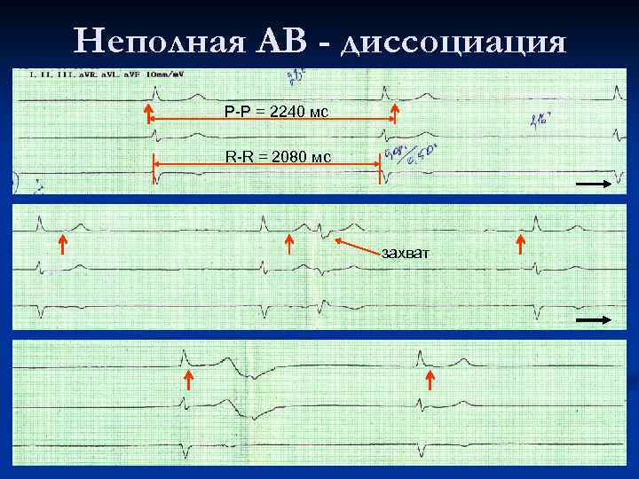 Неполная АВ - диссоциация P-P = 2240 мс R-R = 2080 мс захват 