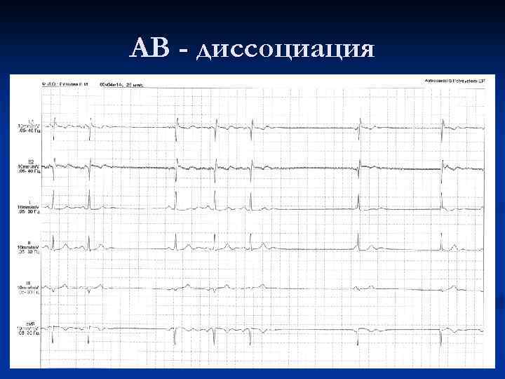 АВ - диссоциация 