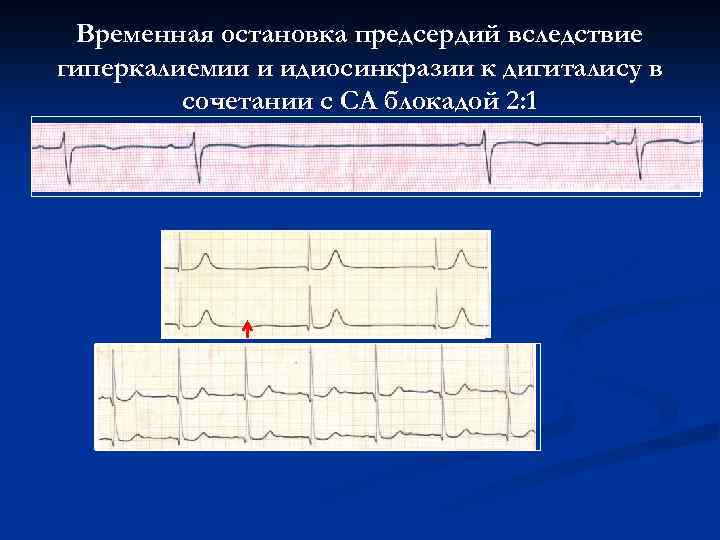 Временная остановка предсердий вследствие гиперкалиемии и идиосинкразии к дигиталису в сочетании с СА блокадой