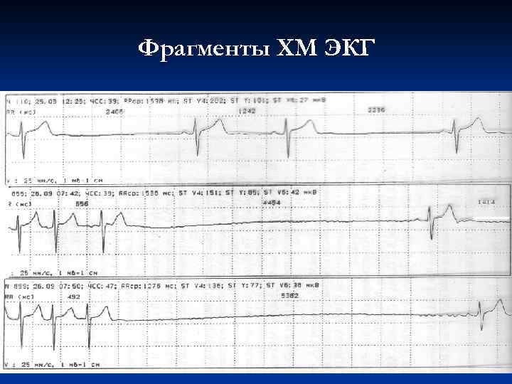 Фрагменты ХМ ЭКГ 
