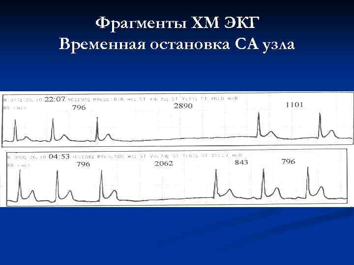 Фрагменты ХМ ЭКГ Временная остановка СА узла 