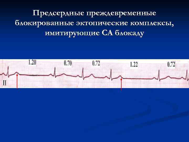 Предсердные преждевременные блокированные эктопические комплексы, имитирующие СА блокаду 