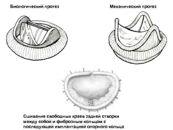 Биологический протез Механический протез Сшивание свободных краев задней створки между собой и фиброзным кольцом