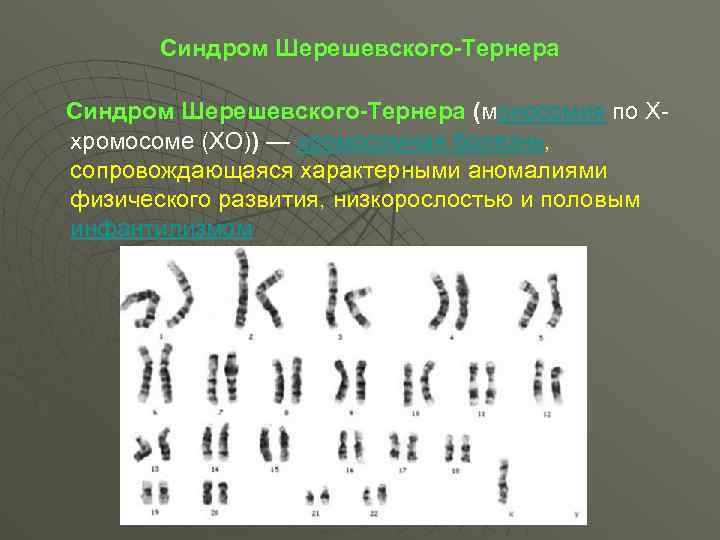 Синдром Шерешевского-Тернера (моносомия по Xхромосоме (XО)) — хромосомная болезнь, сопровождающаяся характерными аномалиями физического развития,