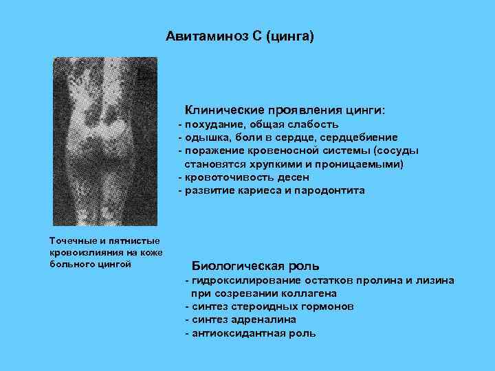 Авитаминоз С (цинга) Клинические проявления цинги: - похудание, общая слабость - одышка, боли в