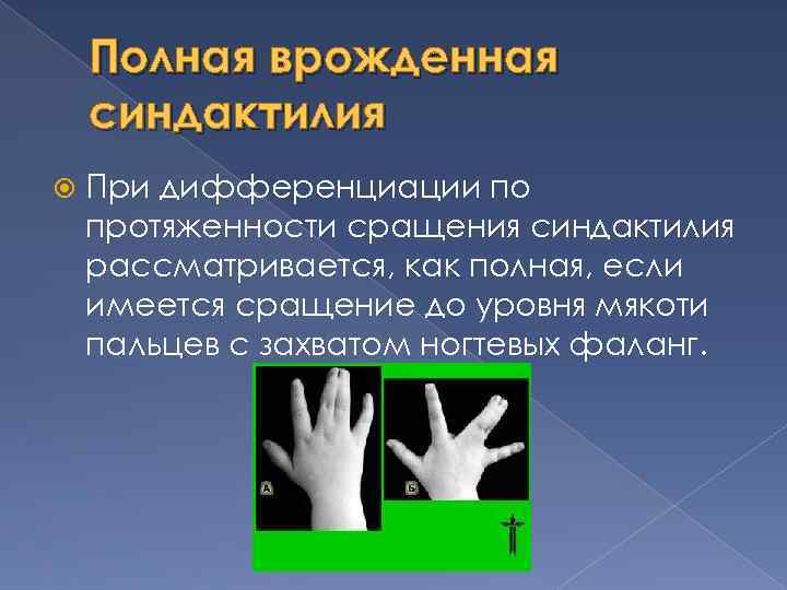 Полная врожденная синдактилия При дифференциации по протяженности сращения синдактилия рассматривается, как полная, если имеется