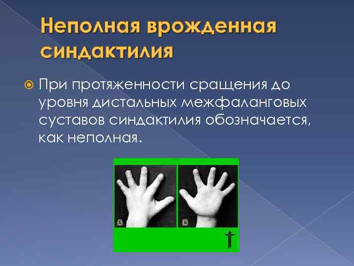 Неполная врожденная синдактилия При протяженности сращения до уровня дистальных межфаланговых суставов синдактилия обозначается, как