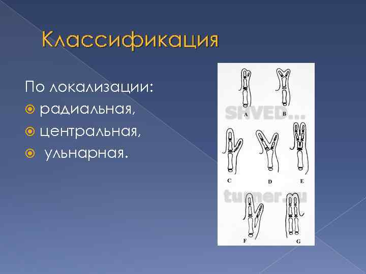 Классификация По локализации: радиальная, центральная, ульнарная. 