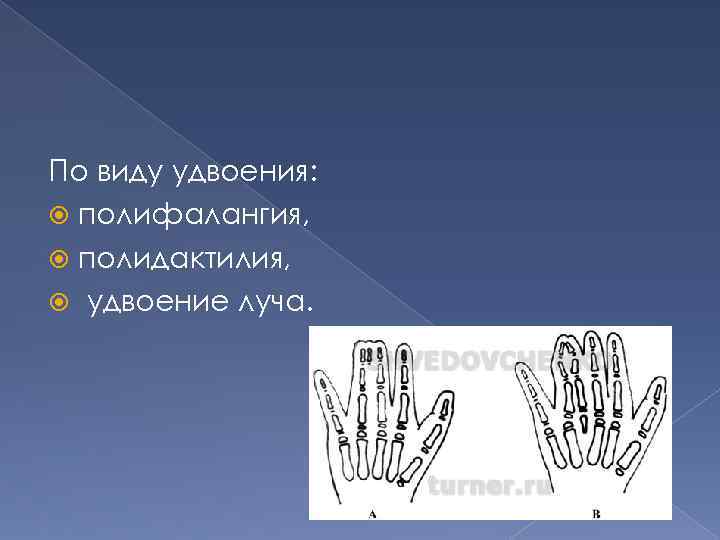 По виду удвоения: полифалангия, полидактилия, удвоение луча. 