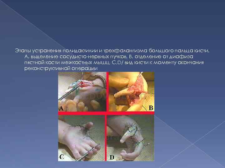 Этапы устранения полидактилии и трехфалангизма большого пальца кисти. А. выделение сосудисто-нервных пучков, В. отделение