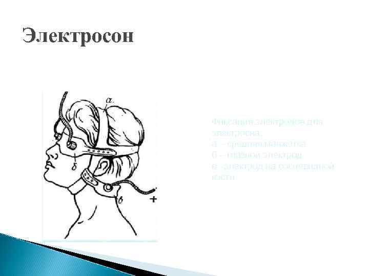 Электросон Фиксация электродов для электросна: а – средняя манжетка б – глазной электрод в