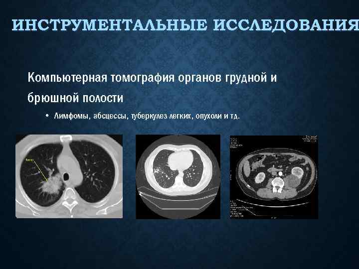 ИНСТРУМЕНТАЛЬНЫЕ ИССЛЕДОВАНИЯ Компьютерная томография органов грудной и брюшной полости • Лимфомы, абсцессы, туберкулез легких,