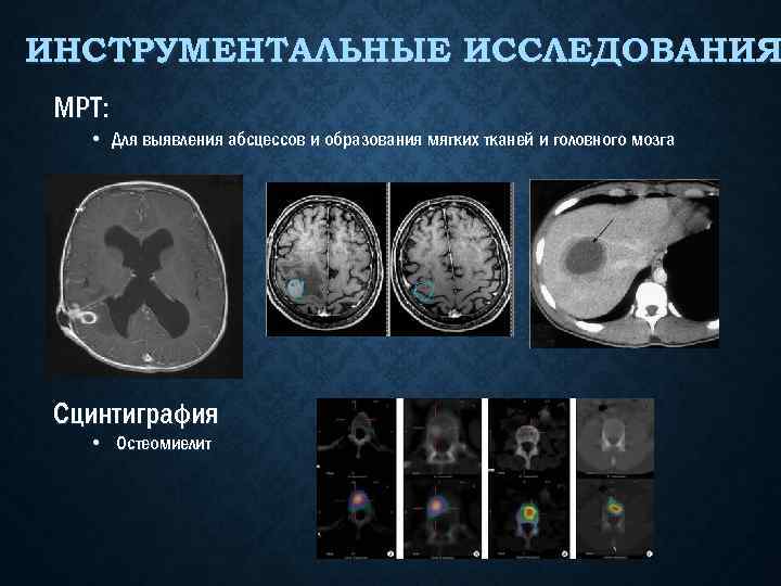 ИНСТРУМЕНТАЛЬНЫЕ ИССЛЕДОВАНИЯ МРТ: • Для выявления абсцессов и образования мягких тканей и головного мозга