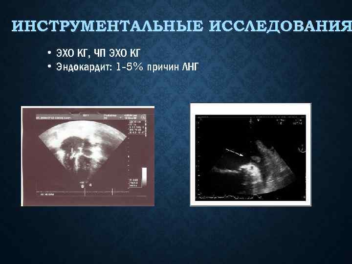 ИНСТРУМЕНТАЛЬНЫЕ ИССЛЕДОВАНИЯ • ЭХО КГ, ЧП ЭХО КГ • Эндокардит: 1 -5% причин ЛНГ