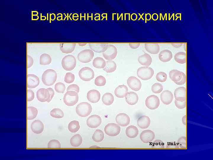 Гипохромия. Гипохромия и гиперхромия. Гипохромия эритроцитов анизохромия. Нормобласты гипохромия. Гипохромия 2.