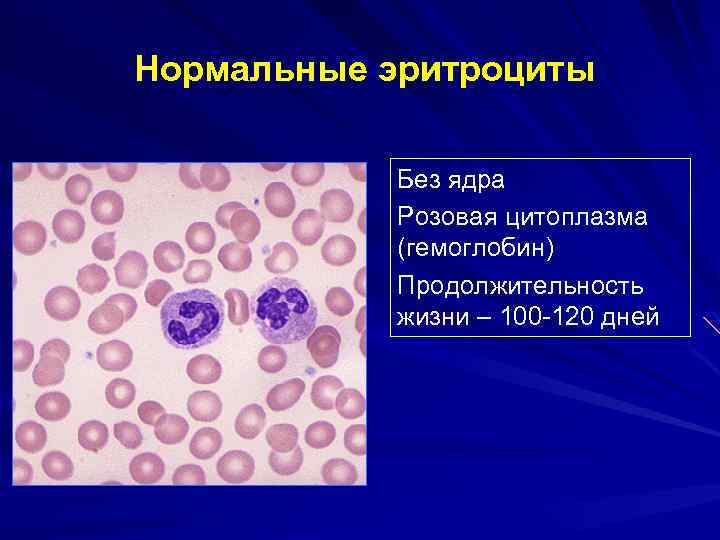 Нормальные эритроциты Без ядра Розовая цитоплазма (гемоглобин) Продолжительность жизни – 100 -120 дней 