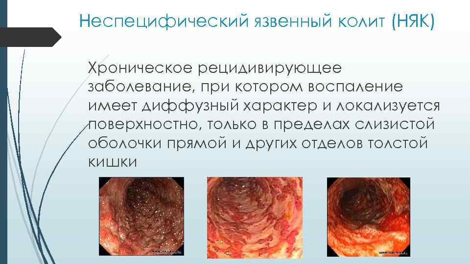 Неспецифический язвенный колит (НЯК) Хроническое рецидивирующее заболевание, при котором воспаление имеет диффузный характер и