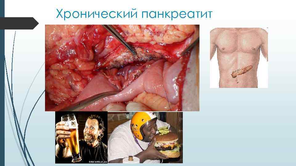 Хронический панкреатит 