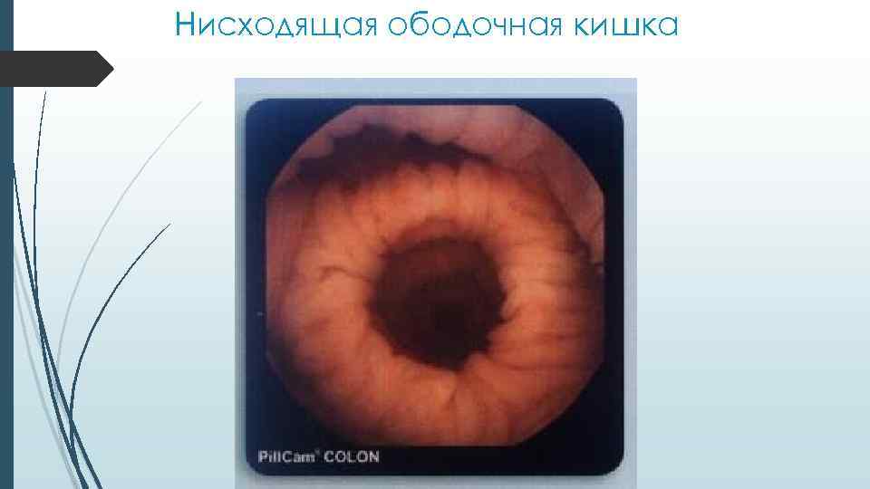 Нисходящая ободочная кишка 