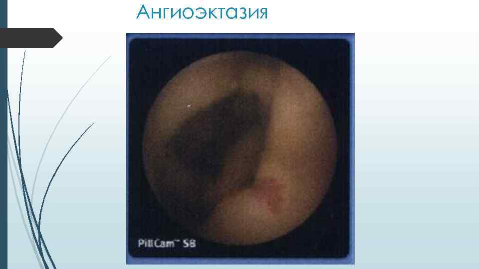 Ангиоэктазия 