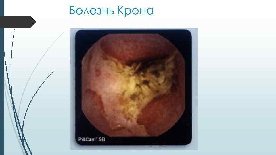 Болезнь Крона 