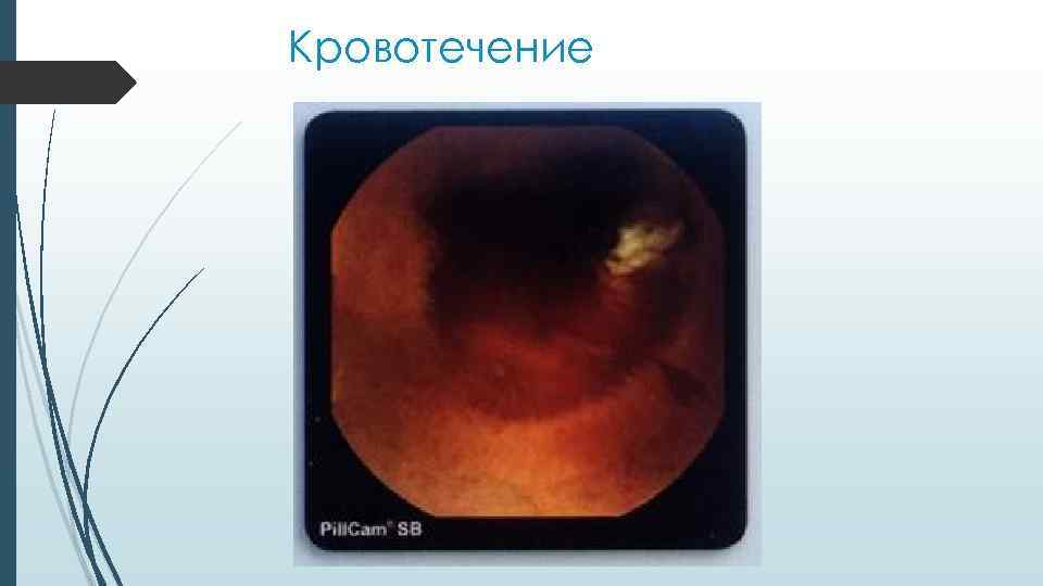 Кровотечение 