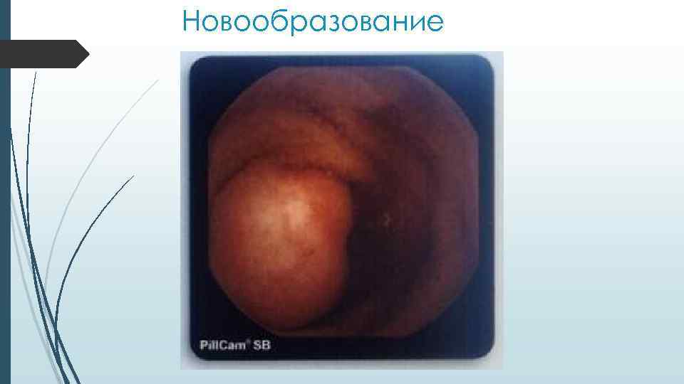 Новообразование 