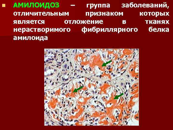 n АМИЛОИДОЗ – группа заболеваний, отличительным признаком которых является отложение в тканях нерастворимого фибриллярного