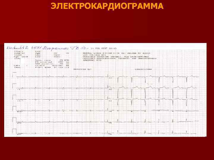 ЭЛЕКТРОКАРДИОГРАММА 