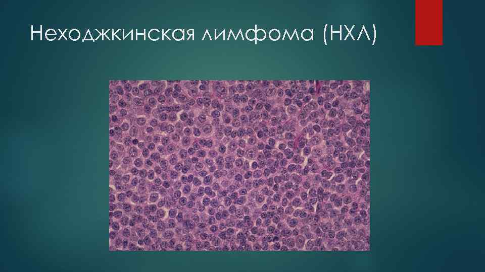 Неходжкинская лимфома (НХЛ) 