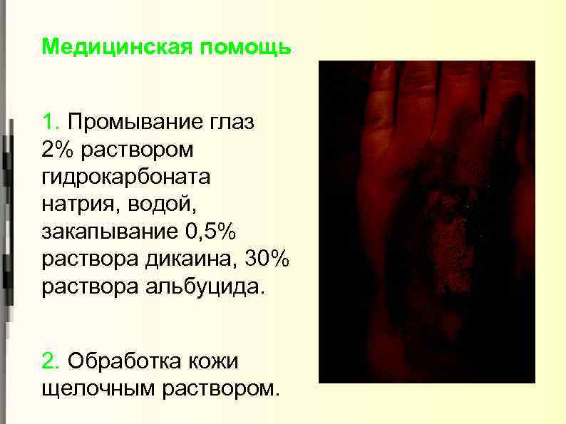 Медицинская помощь 1. Промывание глаз 2% раствором гидрокарбоната натрия, водой, закапывание 0, 5% раствора