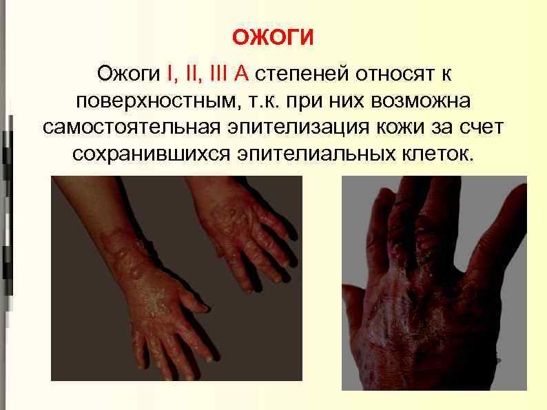 ОЖОГИ Ожоги I, III А степеней относят к поверхностным, т. к. при них возможна